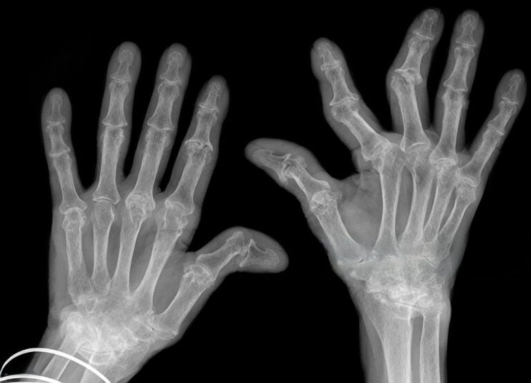 rheumatoid arthritic hands