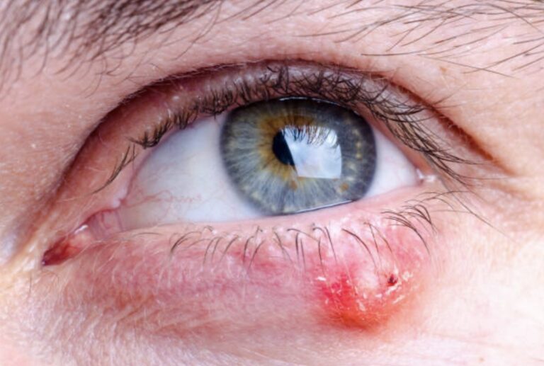 how to get rid of a stye naturally