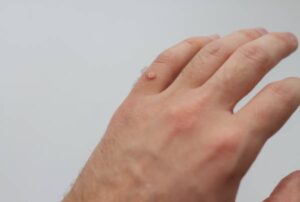 warts on your hand