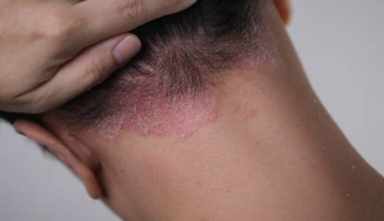 psoriasis on the scalp